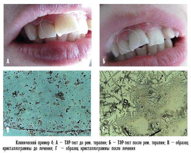Тус мусс гель для зубов. Из клинических примеров видно, что реминерализующий препарат GC Tooth Mousse обладает выраженным терапевтическим эффектом при лечении начального кариеса.